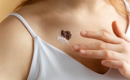 Altas temperaturas em Ribeirão Preto aumentam riscos do câncer de pele